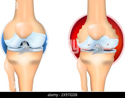 Artrite reumatoide dell'articolazione del ginocchio. L'artrite reumatoide è un tipo infiammatorio. Malattia autoimmune. Artrite erosiva. Illustrazione vettoriale. Illustrazione Vettoriale