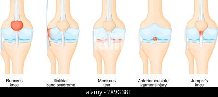 Lesioni alle ginocchia. Anatomia dell'articolazione del ginocchio umano. Lesione del legamento crociato anteriore, ginocchio di Jumper e Runner, tendinite rotulea, lacerazione del menisco, iliotib Illustrazione Vettoriale