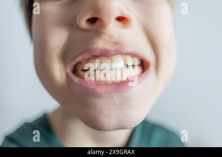 l'adolescente di 12 anni mostra oscillazioni e dolori dei denti, nozione odontoiatria pediatrica, trattamento dentale e correzione dell'occlusione, cura orale, trattamento di Foto Stock