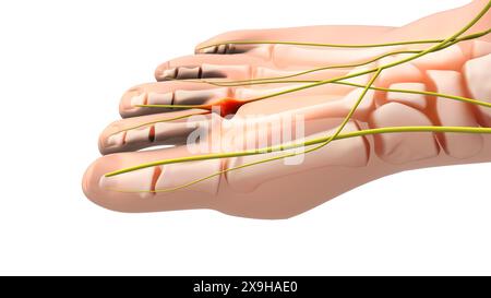 Un neuroma doloroso o nervo schiacciato nel piede Foto Stock