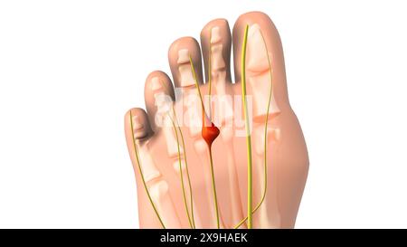 Nervo pizzicato o neuroma animazione medica Foto Stock