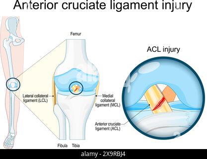 Lesione del legamento crociato anteriore. Primo piano di un'articolazione del ginocchio umano. Trauma al ginocchio come lacerazione o distorsione del legamento crociato anteriore. Infortunio sportivo. Vettore Illustrazione Vettoriale