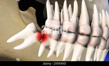 Concetto di saggezza denti dolore Foto Stock