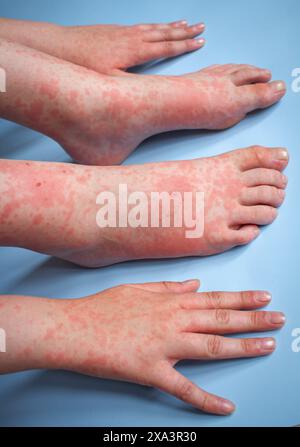 Vista laterale dei piedi e della mano di un adolescente con scossa cutanea causata da allergia cutanea agli antibiotici su sfondo blu Foto Stock