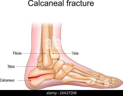 Frattura del calcagno. Trauma dell'osso del tallone. Lesioni al piede. Anatomia delle articolazioni del piede. Illustrazione vettoriale Illustrazione Vettoriale