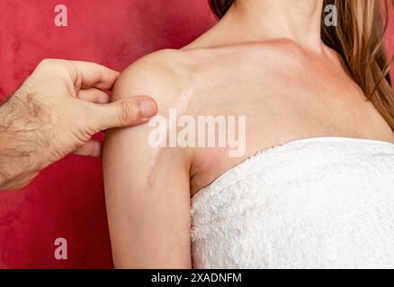 Man Hand esamina una cicatrice postoperatoria sulla spalla di una donna. Guarigione di cicatrici, trattamento di cicatrici sulla pelle Foto Stock