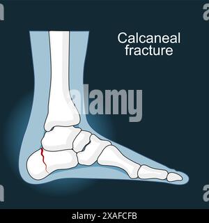 Frattura del calcagno. Trauma dell'osso del tallone. Lesioni al piede. Anatomia delle articolazioni del piede. icone come l'immagine radiografica. Malattia e disturbo nel tallone. Illu vettoriale piatto Illustrazione Vettoriale