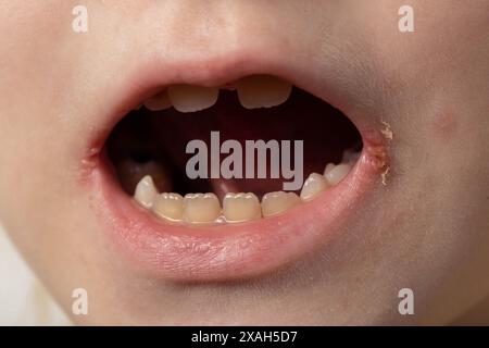 Dolore e prurito agli angoli delle labbra della bocca di una ragazza. Convulsioni sulla pelle, malattia dermatologica batterica. Infezione da herpes, cheil angolare Foto Stock