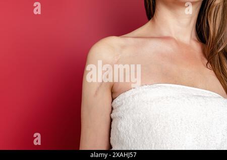 Cicatrice dopo un intervento chirurgico sulla spalla di una donna su sfondo rosso Foto Stock