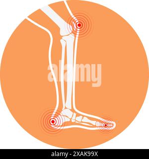 Zone di dolore alle gambe umane. Elementi di progettazione per infografica. Illustrazione Vettoriale