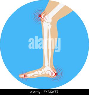 Zone di dolore alle gambe umane. Elementi di progettazione per infografica. Illustrazione Vettoriale