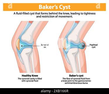 Confronto tra ginocchio sano e cisti di Baker Illustrazione Vettoriale