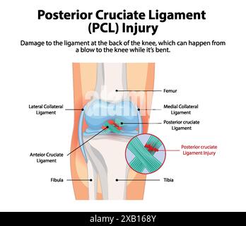 Immagine di una lesione PCL al ginocchio Illustrazione Vettoriale