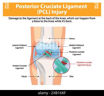 Immagine di una lesione PCL nell'articolazione del ginocchio Illustrazione Vettoriale