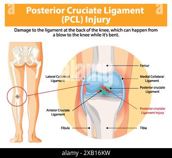 Immagine di lesione PCL e anatomia del ginocchio Illustrazione Vettoriale