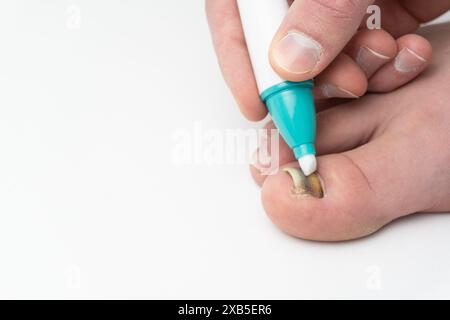 fungine chiodo infezione trattamento con penna primo piano isolato su spazio di copia bianco, mano maschio applicazione, uomo applica trattamento per curare fungo dell'unghia del piede (onyc Foto Stock