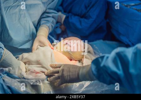 Un bambino viene consegnato in un sacco amniotico intatto durante un taglio cesareo. L'equipe medica esegue con attenzione la procedura, evidenziando il Foto Stock