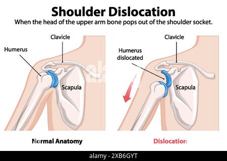 Confronto dell'anatomia spalla normale e dislocata Illustrazione Vettoriale