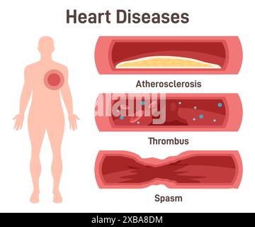 Malattie cardiache. Aterosclerosi, trombo, spasmo coronarico. DHealthy sezione dei vasi sanguigni con accumulo di grasso, coaguli di sangue e spasmo. Illustrazione vettoriale piatta Illustrazione Vettoriale