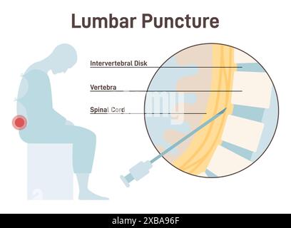 Puntura lombare. Rubinetto spinale, inserimento dell'ago nello spazio tra due vertebre per rimuovere un campione di liquido cerebrospinale. Malattie neurologiche e fisiche diagnostiche. Illustrazione vettoriale piatta Illustrazione Vettoriale