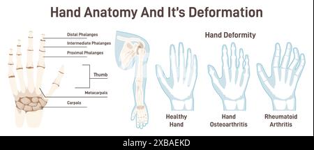 Le ossa delle mani umane e le sue deformazioni. Struttura anatomica con didascalie. Schema di mani sane, dita e falangi del pollice. Mano con artrite reumatoide e osteoartrite. Illustrazione vettoriale piatta Illustrazione Vettoriale