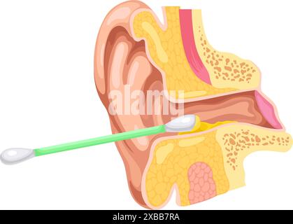 Pulizia del canale uditivo. Orecchie pulizia delle orecchie all'interno con tampone di cotone, concetto di otorinolaringoiatria anatomia di primo piano del canale di orecchio problema di cerume sporco della cera, ingegnosa illustrazione vettoriale dell'orecchio della cera Illustrazione Vettoriale