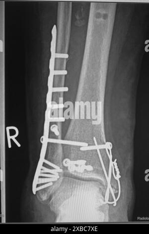 Una radiografia mostra una frattura della caviglia dopo l'intervento chirurgico Foto Stock
