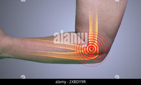 Sindrome del tunnel carpale del gomito da tennis Foto Stock