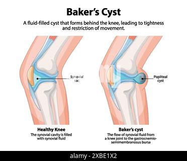 Confronto tra ginocchio sano e cisti di Baker Illustrazione Vettoriale