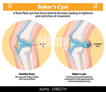 Confronto tra ginocchio sano e cisti di Baker Illustrazione Vettoriale