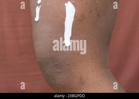 Lozione sulla pelle marrone con eczema, applicazione lozione sulla dermatite atopica e prurigo nodularis sulla pelle marrone gamba, applicazione di unguento su eczema breakou Foto Stock