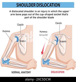 Schema di spiegazione della lussazione della spalla e del trauma osseo dell'omero. Braccio doloroso vs sano. Etichettato lesioni mediche educative Illustrazione Vettoriale