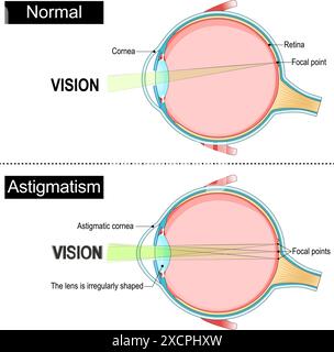 Astigmatismo. Anatomia degli occhi. Obiettivo, cornea e punti focali sulla retina nell'occhio normale e astigmatico. Sezione trasversale di un occhio umano. Diagramma per l'istruzione Illustrazione Vettoriale