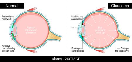 Glaucoma. Sezione trasversale di un occhio umano. Pressione intraoculare. Perdita della vista. Anatomia degli occhi. Diagramma per l'istruzione e l'uso medico. Illustrazione vettoriale Illustrazione Vettoriale