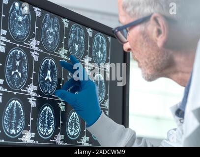 Lo scienziato che osserva la risonanza magnetica cerebrale di un paziente esegue la scansione per rilevare l'invecchiamento e i danni dovuti alla demenza e al morbo di Alzheimer. Foto Stock