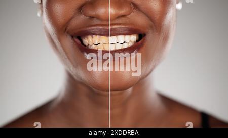 Collage dentale che mostra i denti di una donna afroamericana sorridente prima e dopo un trattamento sbiancante. Trasformazione odontoiatrica da parte di professionisti. Foto Stock