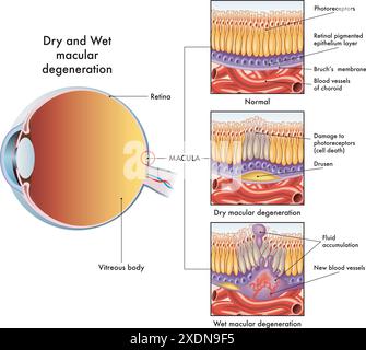 L'illustrazione medica mostra i sintomi che interessano un occhio colpito da maculopatia secca e bagnata, con annotazioni. Illustrazione Vettoriale