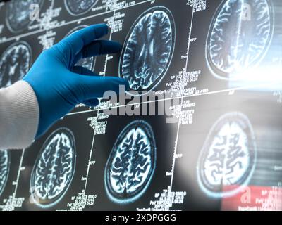 Neurology Research, Dottore visualizzazione di un paziente MRI Scan for Damage Foto Stock