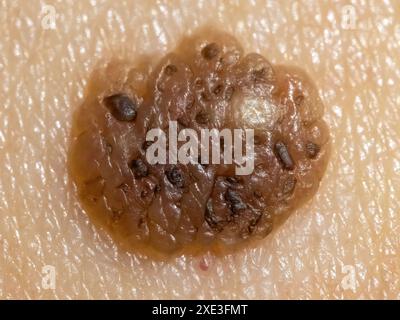 Una vista macro dettagliata di una talpa con potenziali indicazioni di melanoma maligno. Concetto: Cancro della pelle Foto Stock