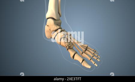 Cancro che si diffonde lungo un meta-catrame osseo del piede Foto Stock