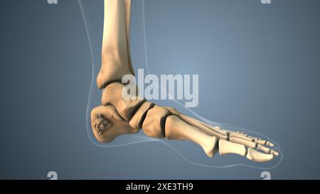 Diffusione del cancro lungo l'osso del piede Foto Stock