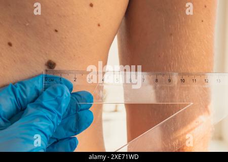 Dermatologo che controlla le dimensioni delle voglie maschili con il righello. Medico che esamina la lunghezza e la larghezza dei nei benigni sulla pelle dell'uomo Foto Stock