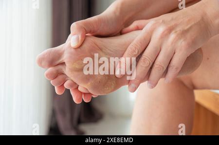 sono necessari piedi sporchi e trascurati, cura e pedicure Foto Stock