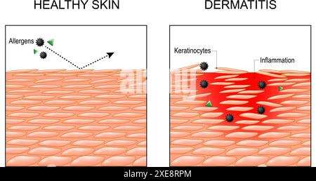 Dermatite. Eczema. Psoriasi. Sezione trasversale di una pelle umana. Primo piano dell'epidermide infiammatoria. Penetrazione di allergeni nella pelle. Dermatite atopica. Illustrazione Vettoriale