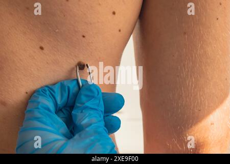 Medico in guanti medici che esaminano la talpa della pelle dell'uomo per la dimensione. Dermatologo che controlla le voglie maschili. Cura di sé per prevenire il cancro p Foto Stock