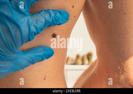 Dermatologo che controlla le voglie maschili per cambiare le dimensioni. Ricontrollo annuale. Medico in guanti medici che esaminano la talpa della pelle dell'uomo. S Foto Stock