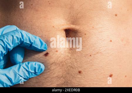 Dermatologo che controlla le voglie maschili. Medico in guanti medici che esaminano la talpa della pelle dell'uomo. Autoassistenza per prevenire il cancro. Foto Stock