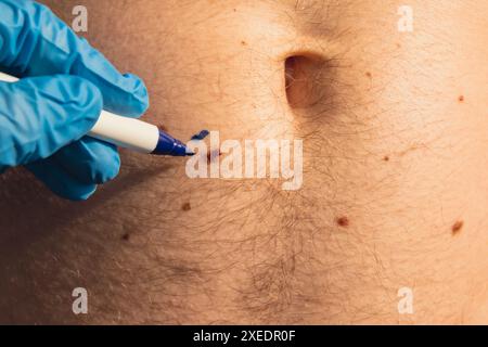 Preparazione della procedura per la chirurgia medica della pelle. Medico irriconoscibile in guanti medici linee di vernice intorno a voglie maschili. Laser Foto Stock