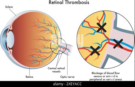 L'illustrazione medica mostra le conseguenze della trombosi retinica Illustrazione Vettoriale