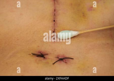 Medico che utilizza alcool e cotone bud pulizia ferita da chirurgia a cuore aperto sul corpo femminile (rigurgito della valvola cardiaca) Foto Stock